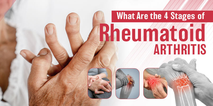 What Are the 4 Stages of Rheumatoid Arthritis?