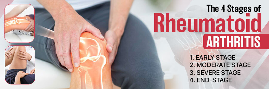 The 4 Stages of Rheumatoid Arthritis